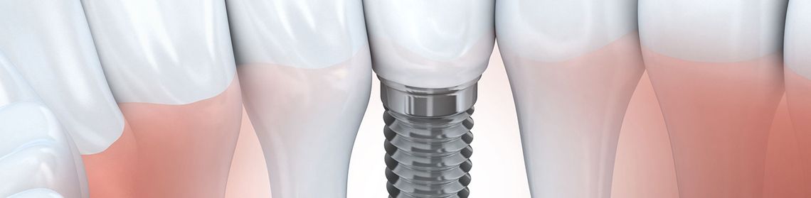 clinica-odontologica-aragon-gracia-implantes